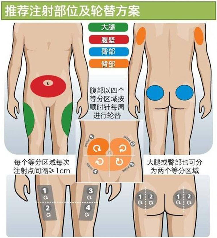 胰岛素注射部位图解