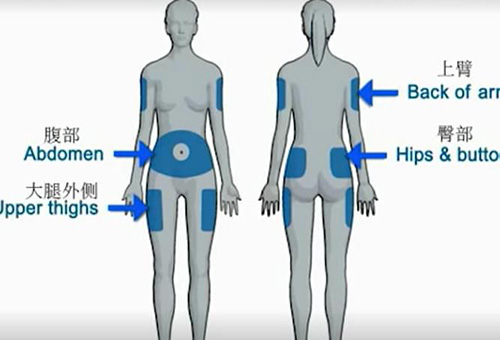 胰岛素泵扎针部位的注意事项