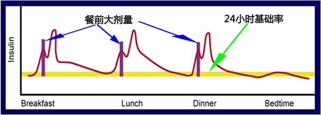 丹纳胰岛素泵精准调节输注剂量方法