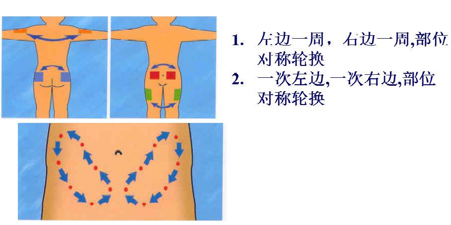 丹纳胰岛素泵